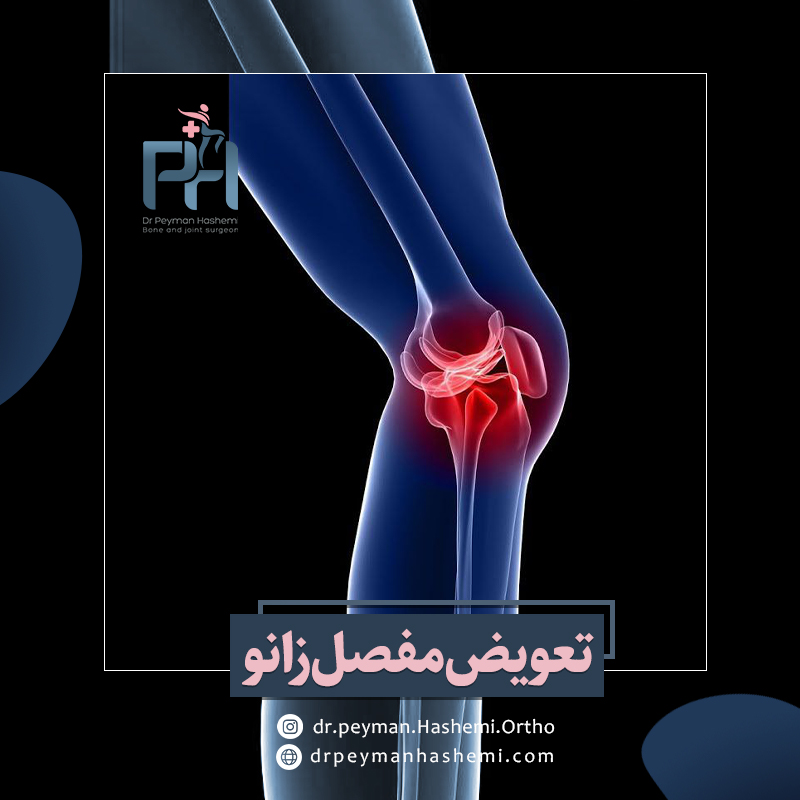 عمل تعویض مفصل زانو چیست؟