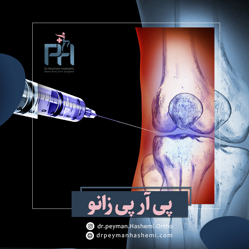 پی آر پی زانو