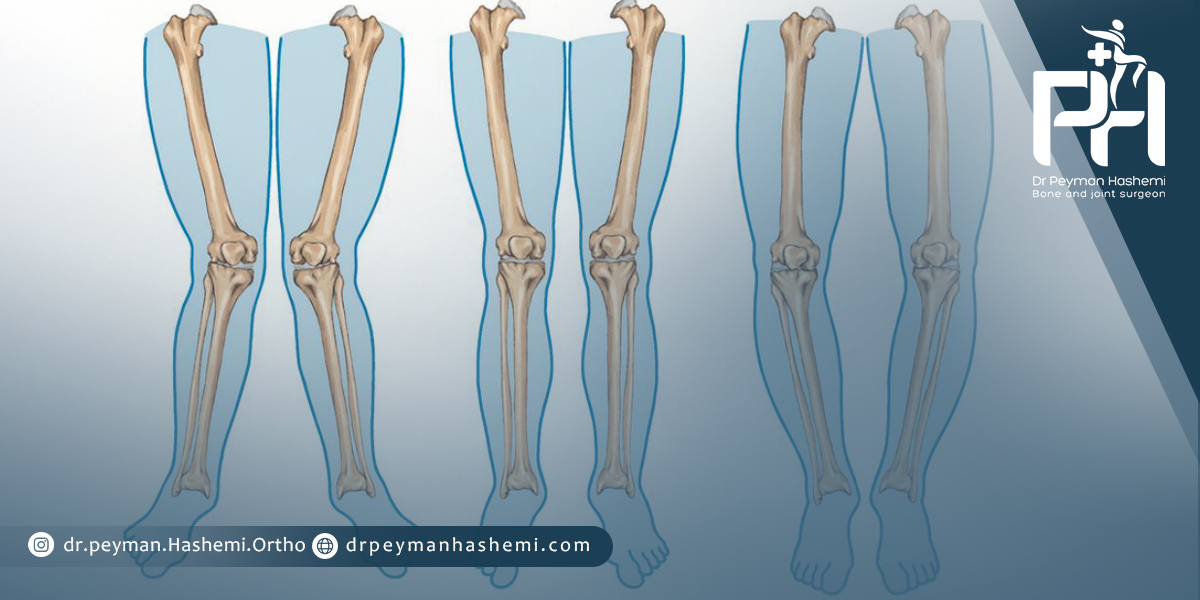 علت پرانتزی شدن زانو چیست؟