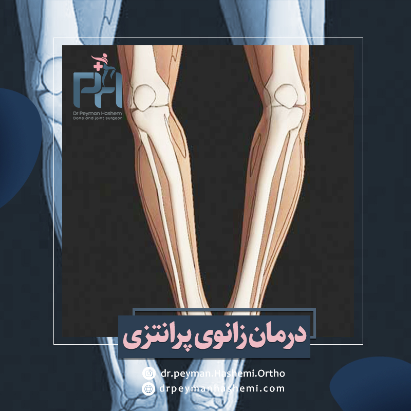 درمان زانوی پرانتزی