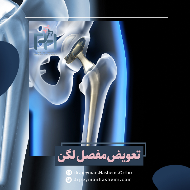 تعویض مفصل لگن