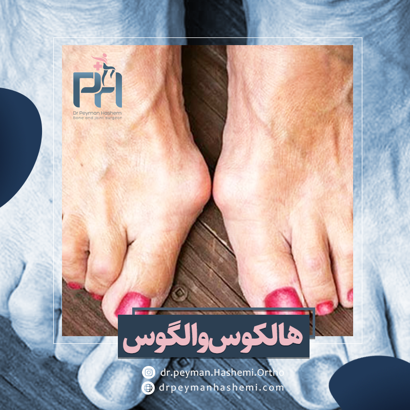 هالکوس والگوس