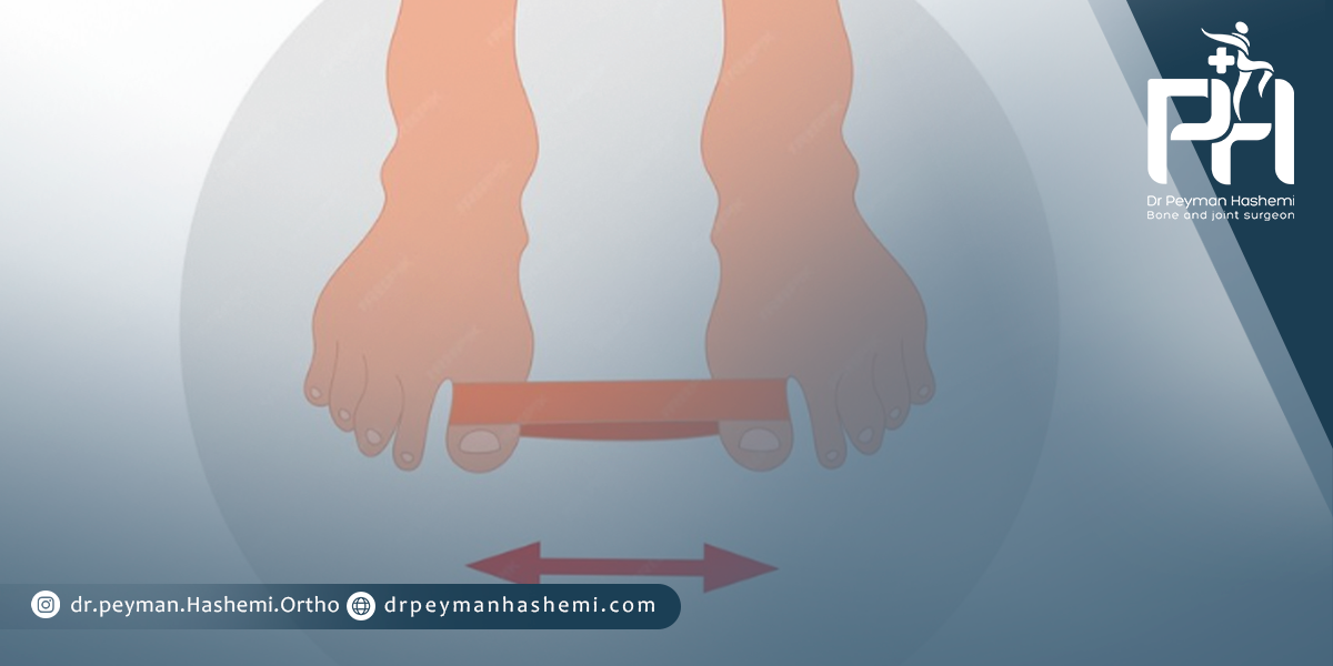 پیشگیری از ابتلا به هالگوس والگوس