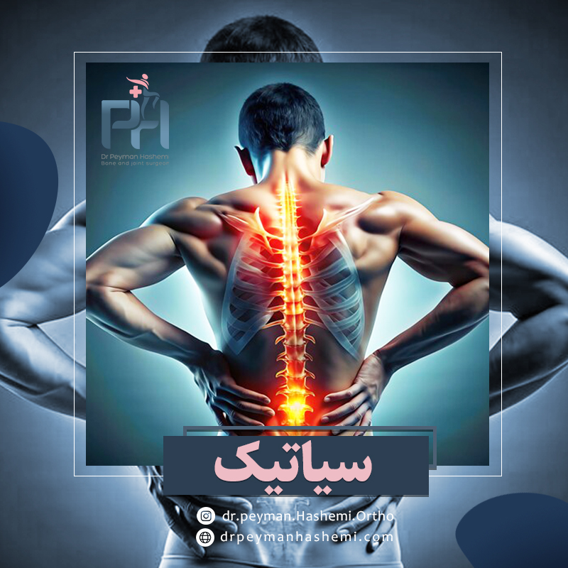 درمان درد سیاتیک