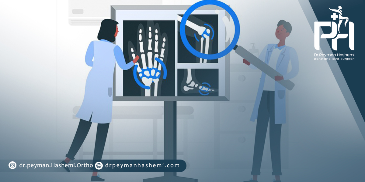 چه استخوان هایی بیشتر دچار شکستگی می شوند؟