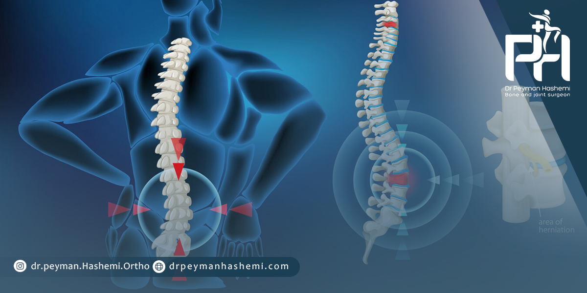 وظیفه و عملکرد دیسک کمر