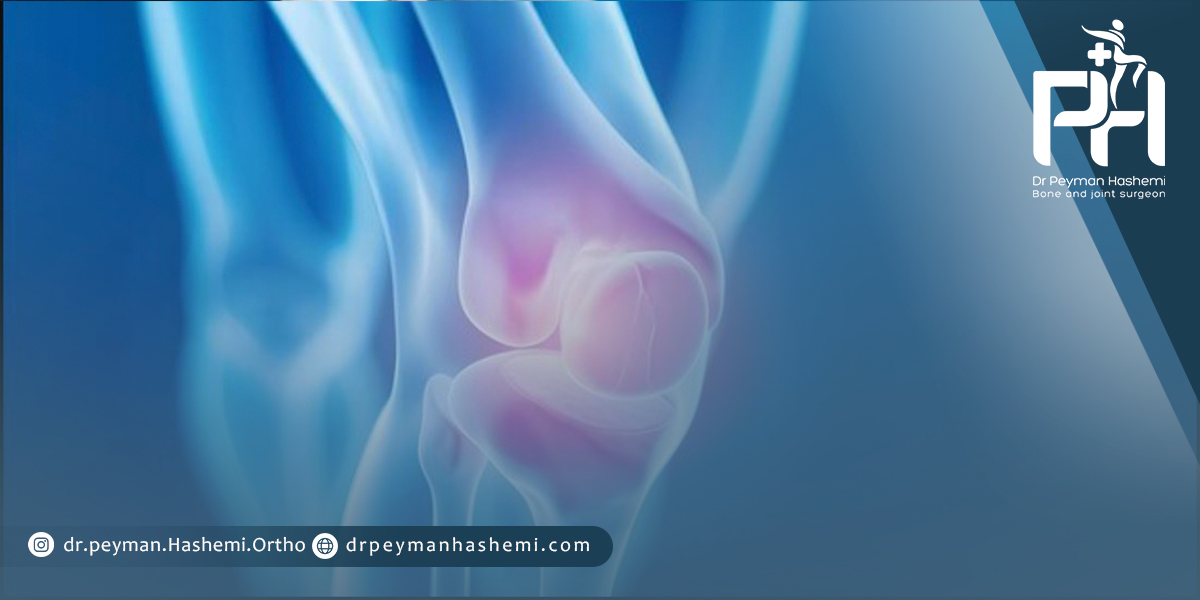تعویض مفصل زانو در بیماران دیابتی