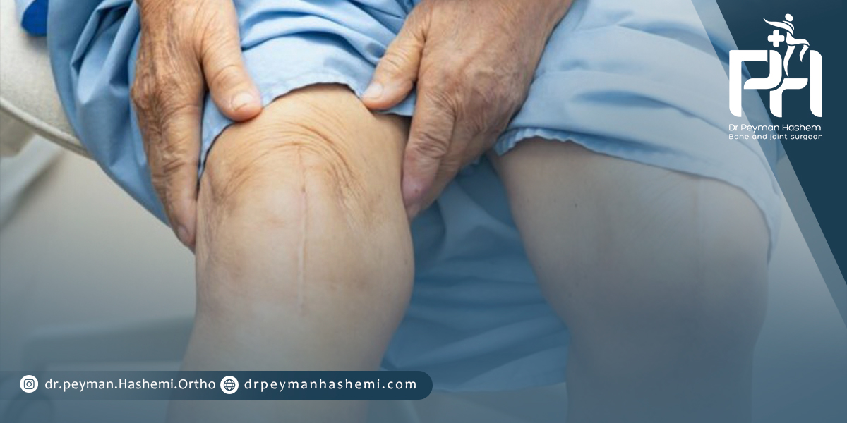 تعویض کردن مفصل زانو در بیماران دیابتی با چه مزایایی همراه است؟