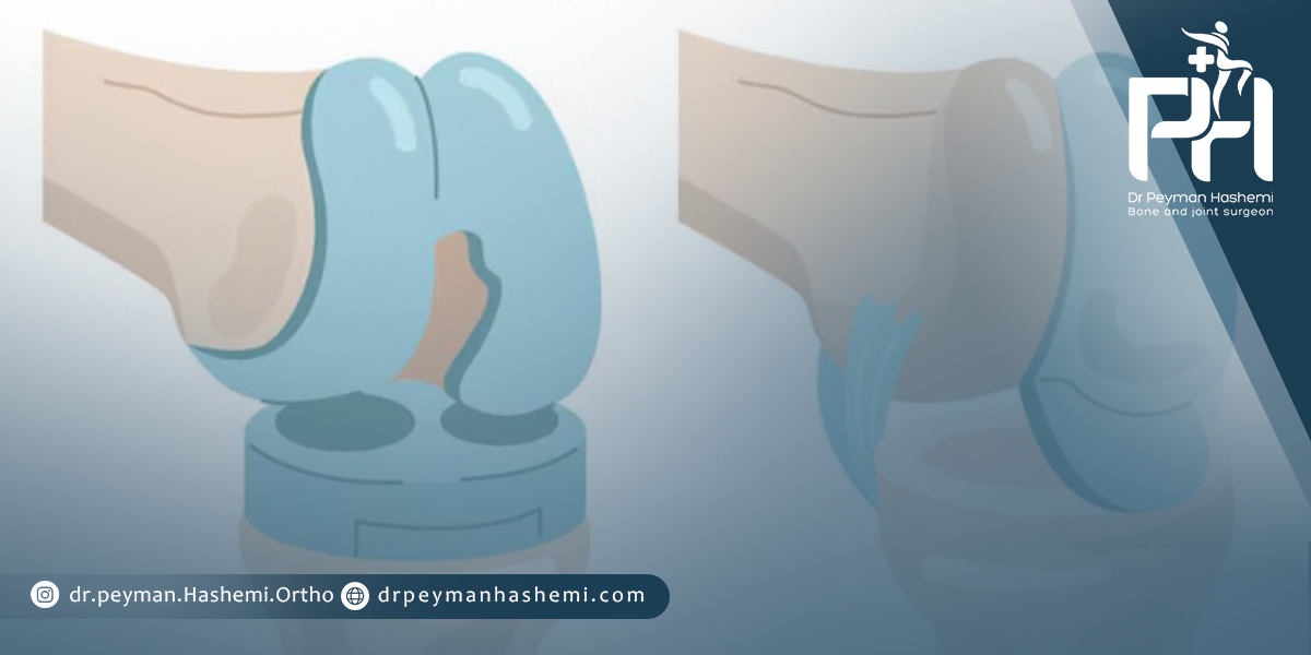 پیشگیری از ورم بعد از جراحی زانو
