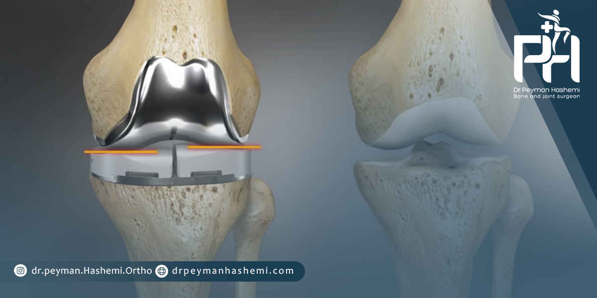درمان‌های جایگزین تعویض زانو