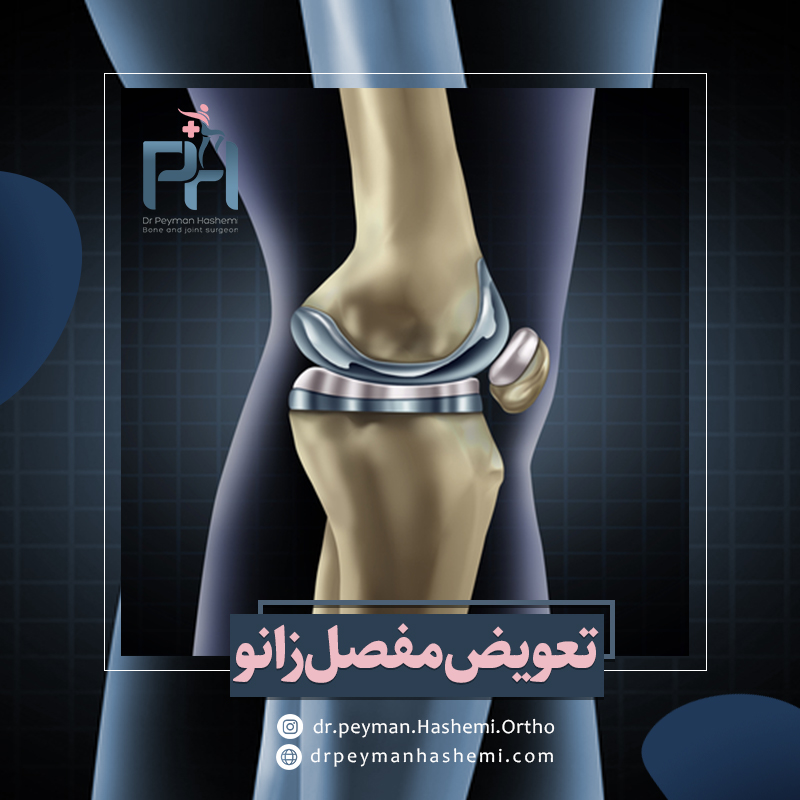 عوارض تعویض مفصل زانو