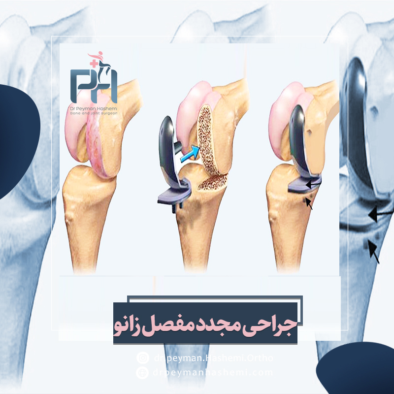 جراحی مجدد تعویض مفصل زانو